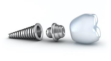 illustration of a dental implant in Lake Oswego, OR