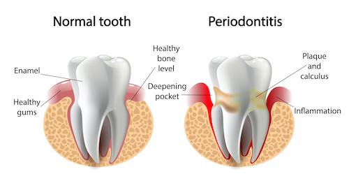 gum disease treatment lake oswego | periodontitis diagram