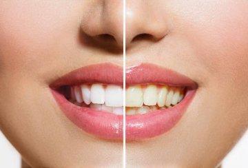 teeth whitening lake oswego