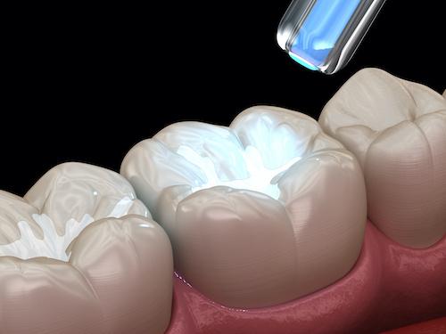 fillings lake oswego | fillings procedure