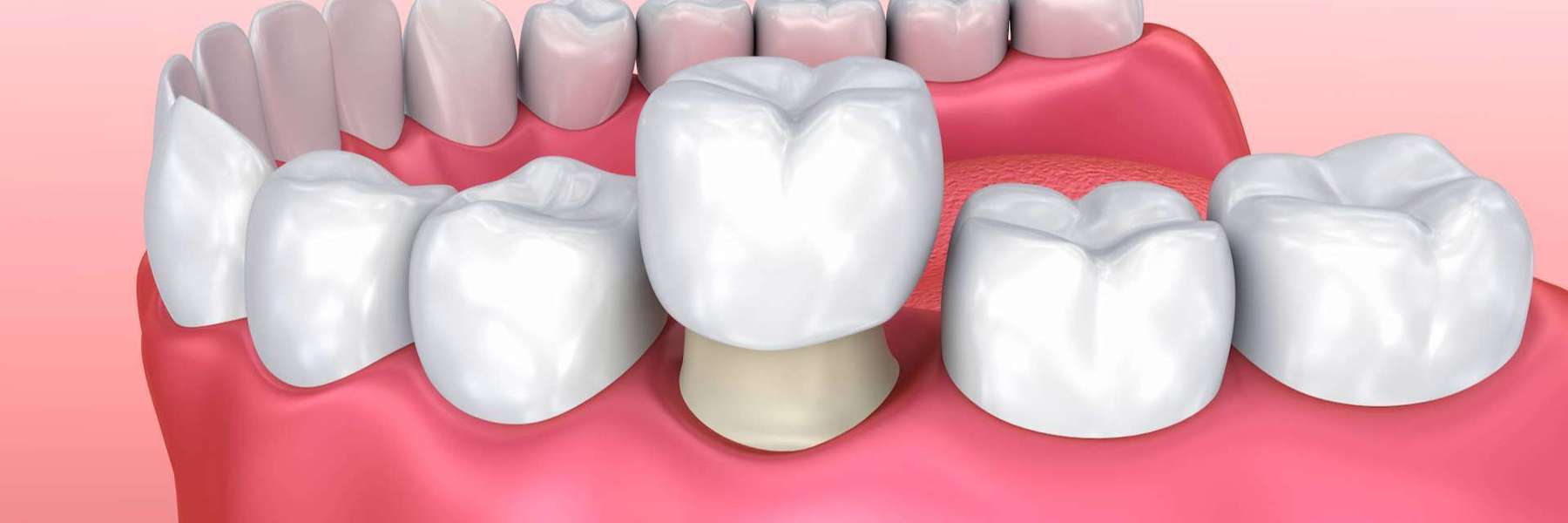 Illustration of holistic dental crown in lake oswego, OR