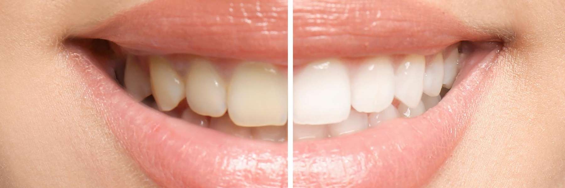 a smile after whitening treatment with lake oswego dentist