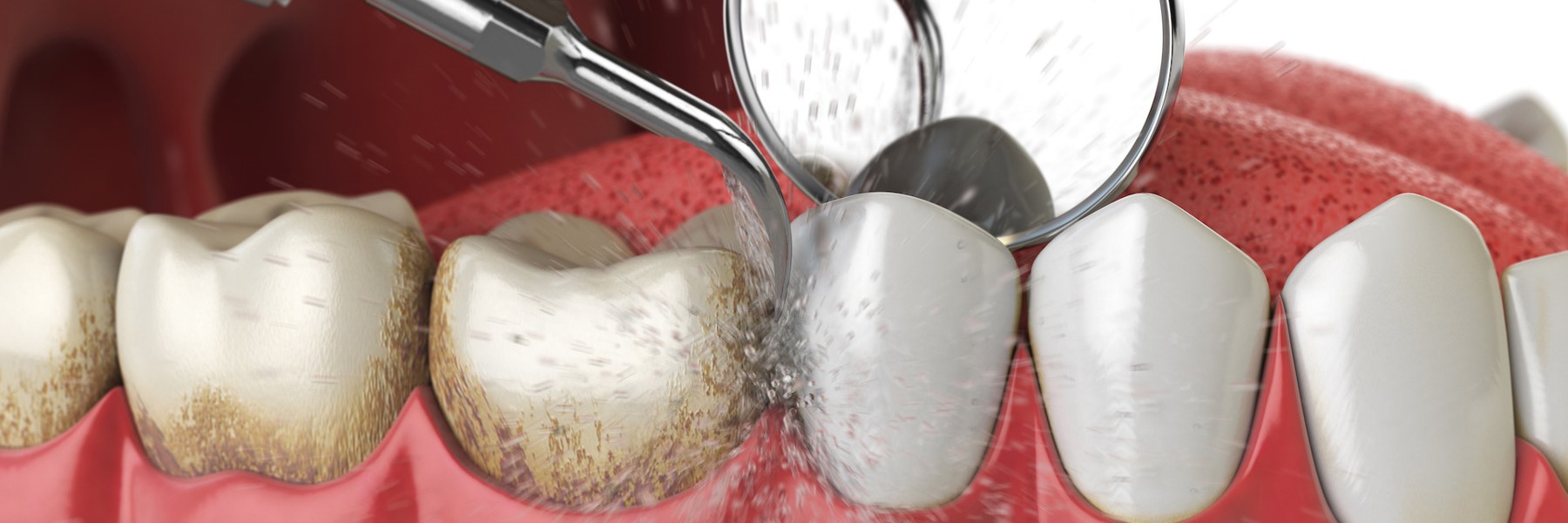 illustration of teeth cleaning in lake oswego, or