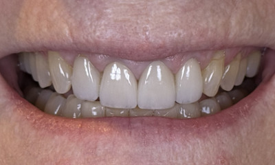 complete smile after restorations placed on front teeth in lake oswego