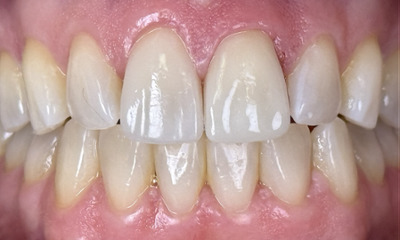 After treatment - Traveling for Expert Smile Restoration