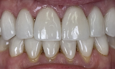 After treatment - Veneer Replacement and Smile Rejuvenation