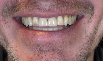 After treatment - Veneers