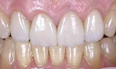 Top teeth smile restoration after treatment in lake oswego