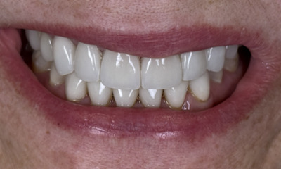 smile after old veneers showing wear were replaced in lake oswego, or