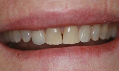 smile before restorations placed on front teeth in lake oswego