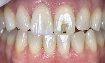 Before treatment - Traveling for Expert Smile Restoration