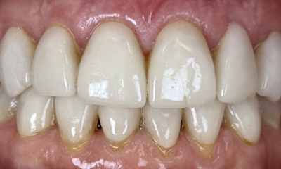 Before treatment - Veneer Replacement and Smile Rejuvenation