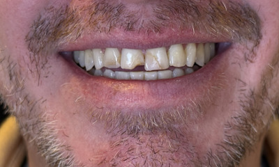 Before treatment - Veneers