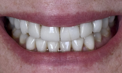smile with old veneers showing wear before smile makeover