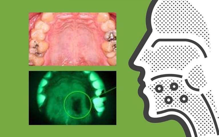 lake oswego dentist | oral cancer screening